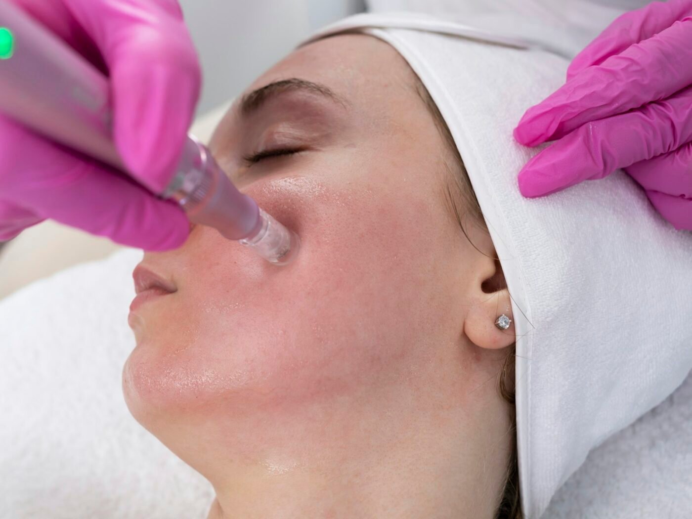 Acne & Scar Treatment