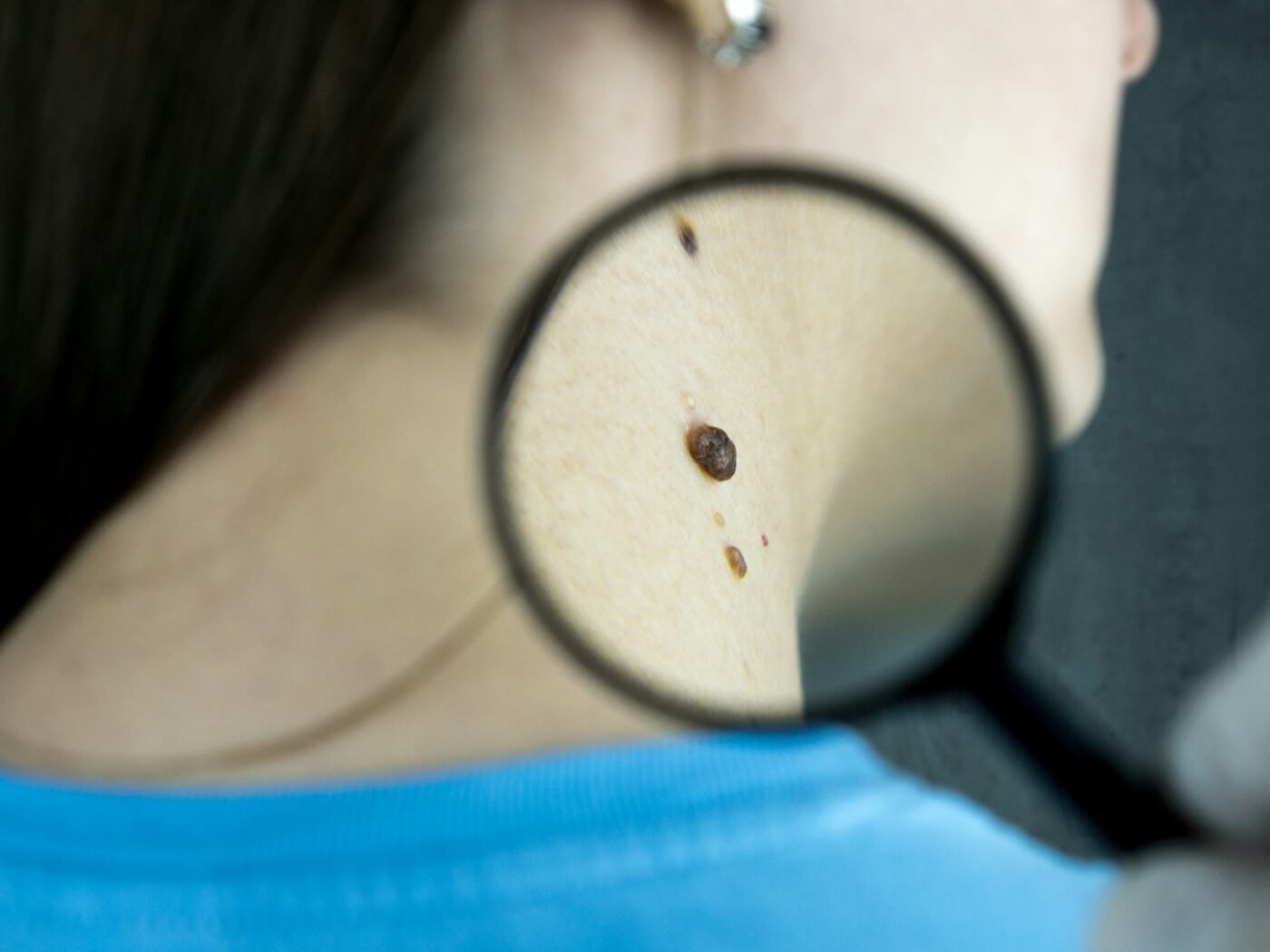 Pigmentation & Melasma Treatment
